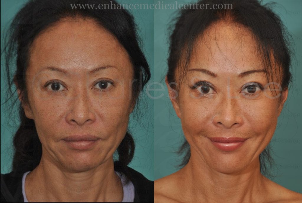 Eyelids Rhinoplasty Jaw Reduction Cheeks Brow Lift Mid Face Lift Face ...