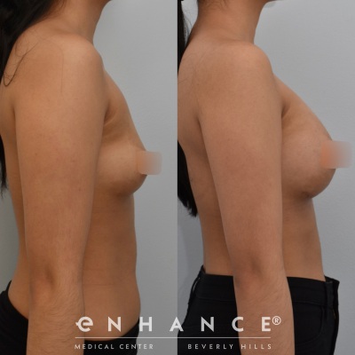 breast augmentation