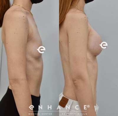 breast augmentation