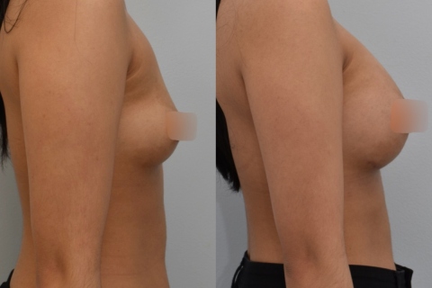 breast augmentation