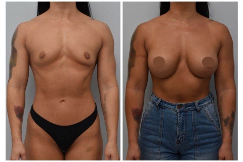 breast augmentation