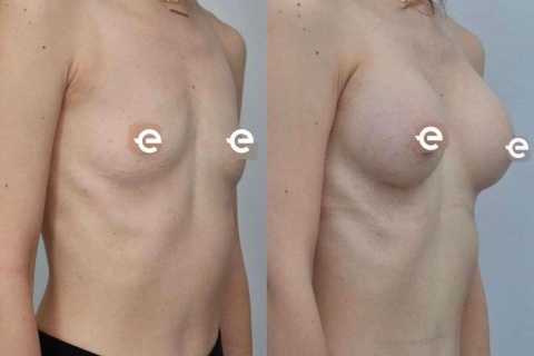 breast augmentation