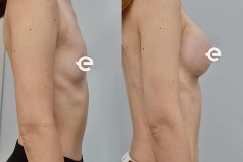 breast augmentation