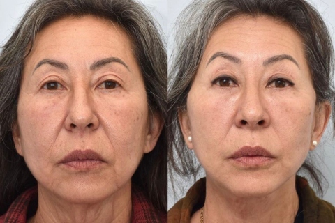 Facelift