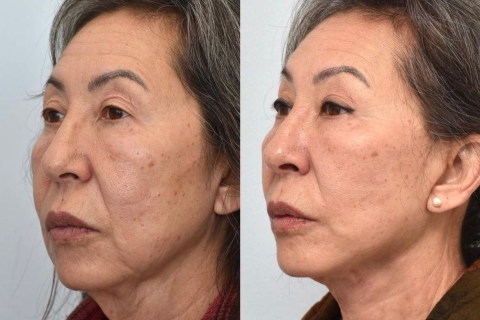 Facelift