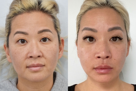 Facelift