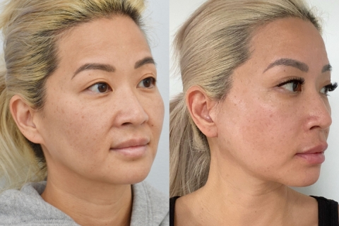 Facelift