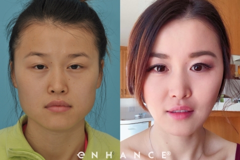 Cheek Reduction Before & After Gallery