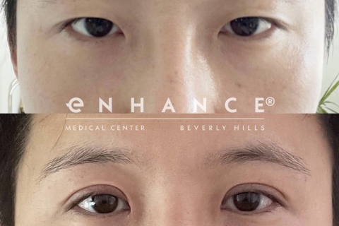 blepharoplasty