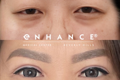 blepharoplasty