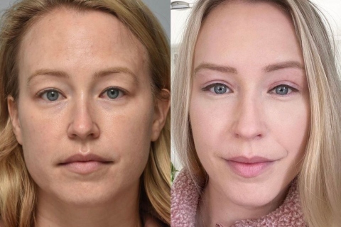 blepharoplasty and browlift