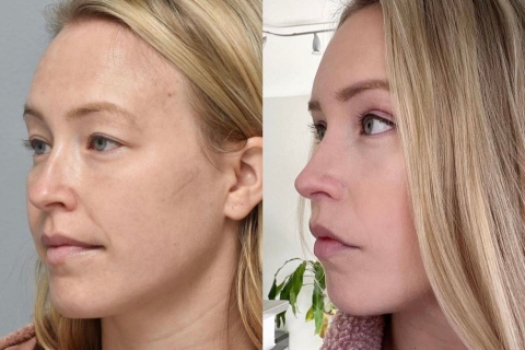 blepharoplasty and browlift