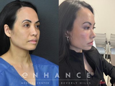 Before and afters - 212