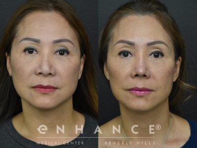 Before and afters - 227