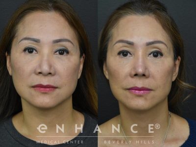 Before and afters - 227