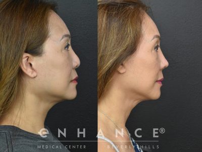 Before and afters - 228