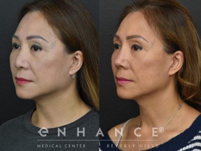 Before and afters - 229