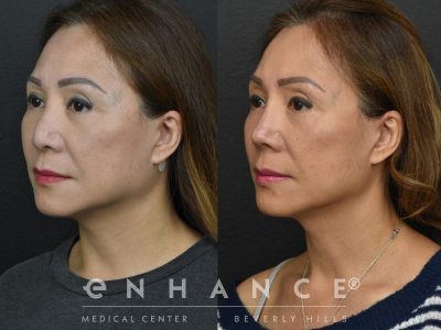 Before and afters - 229