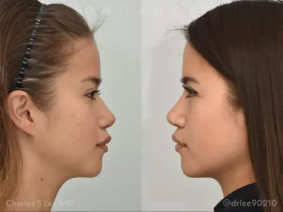 rhinoplasty-101