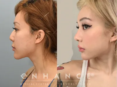 rhinoplasty-25