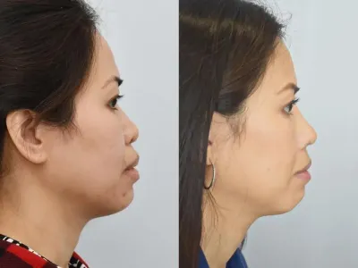 rhinoplasty-26