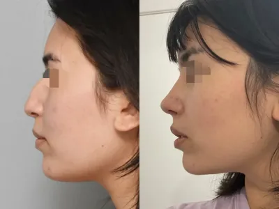 rhinoplasty-47