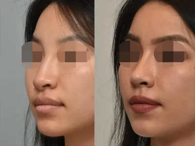 rhinoplasty-51