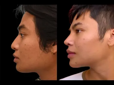 rhinoplasty-62