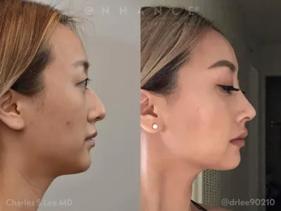 rhinoplasty-65