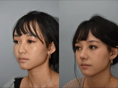 rhinoplasty-74