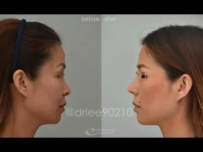 rhinoplasty-75