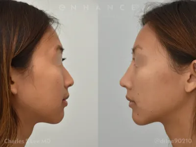 rhinoplasty-90