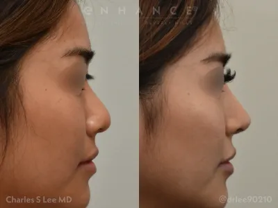 rhinoplasty-93