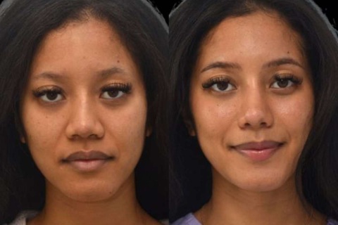 revision rhinoplasty