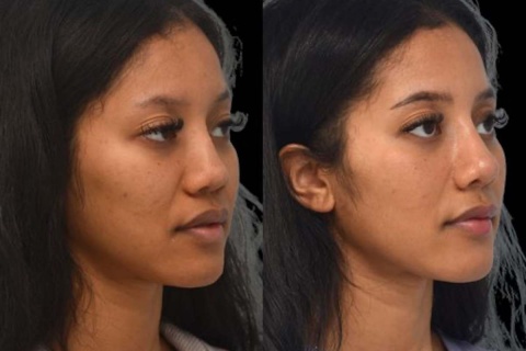 revision rhinoplasty