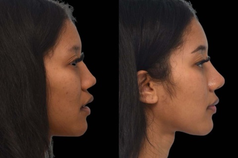revision rhinoplasty
