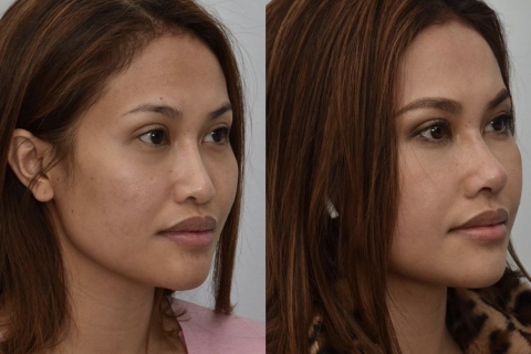 revision rhinoplasty with rib