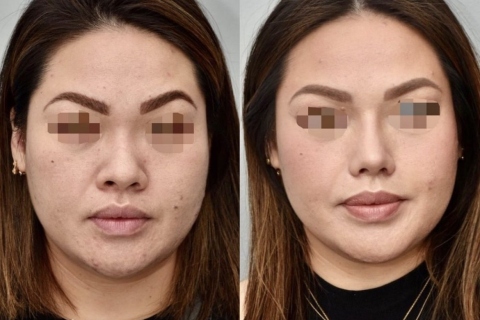 rhinoplasty with rib