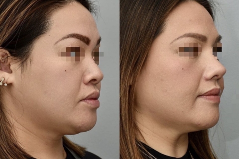 rhinoplasty with rib
