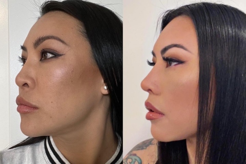 charles-s-lee-rhinoplasty-063022-08-side.jpg