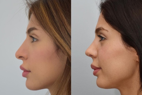 revision rhinoplasty with rib