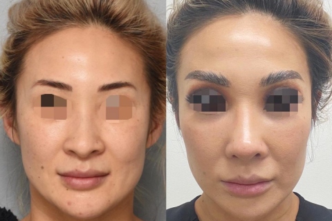 rhinoplasty with rib