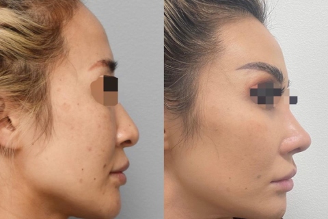 rhinoplasty with rib