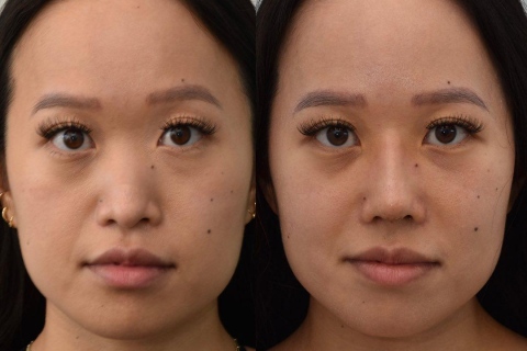 rhinoplasty with rib