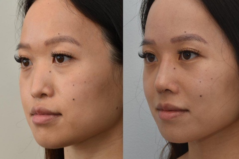 rhinoplasty with rib