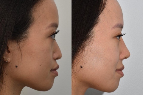 rhinoplasty with rib