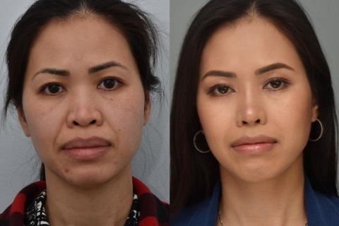 rhinoplasty and lip reduction