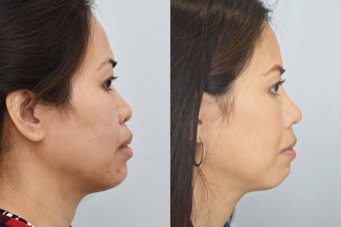 rhinoplasty and lip reduction