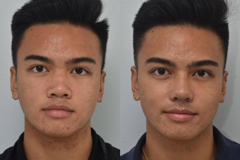 rhinoplasty with rib