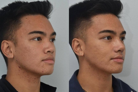 rhinoplasty with rib